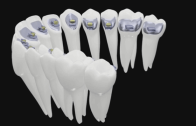 ortodontia lingual digital autoligada da American Orthodontics