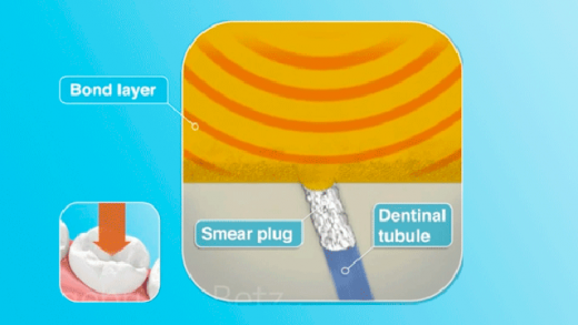 Adesivo sobre dentina mostrando túbulos dentinários preenchidos evitando dor pós-operatória