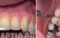 Recobrimento radicular com cirurgia plástica periodontal