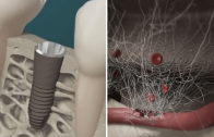 osseointegração de implante dentário